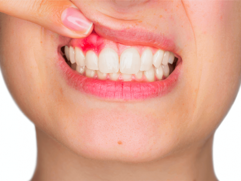Лазерное лечение кисты зуба красноярск